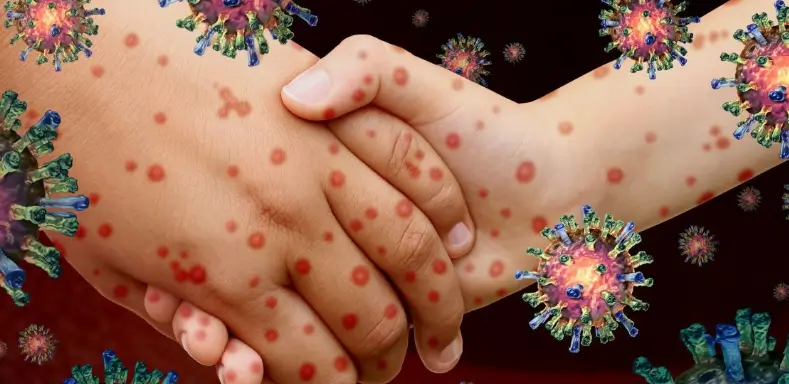 Qizilcha toshmasi va kasalligi, sababi va davolash