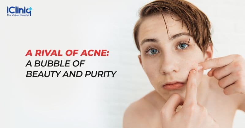 Akne raqibi: go’zallik va poklik pufakchasi