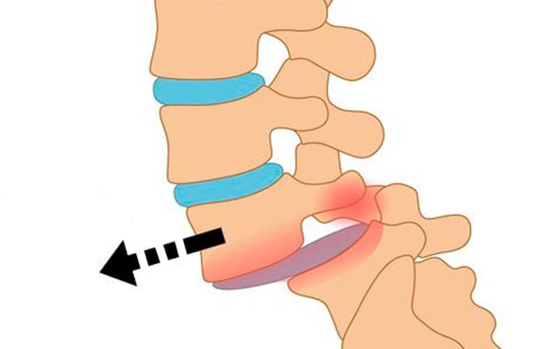 Umurtqalarning siljishi — spondilolistez sababi va davolash