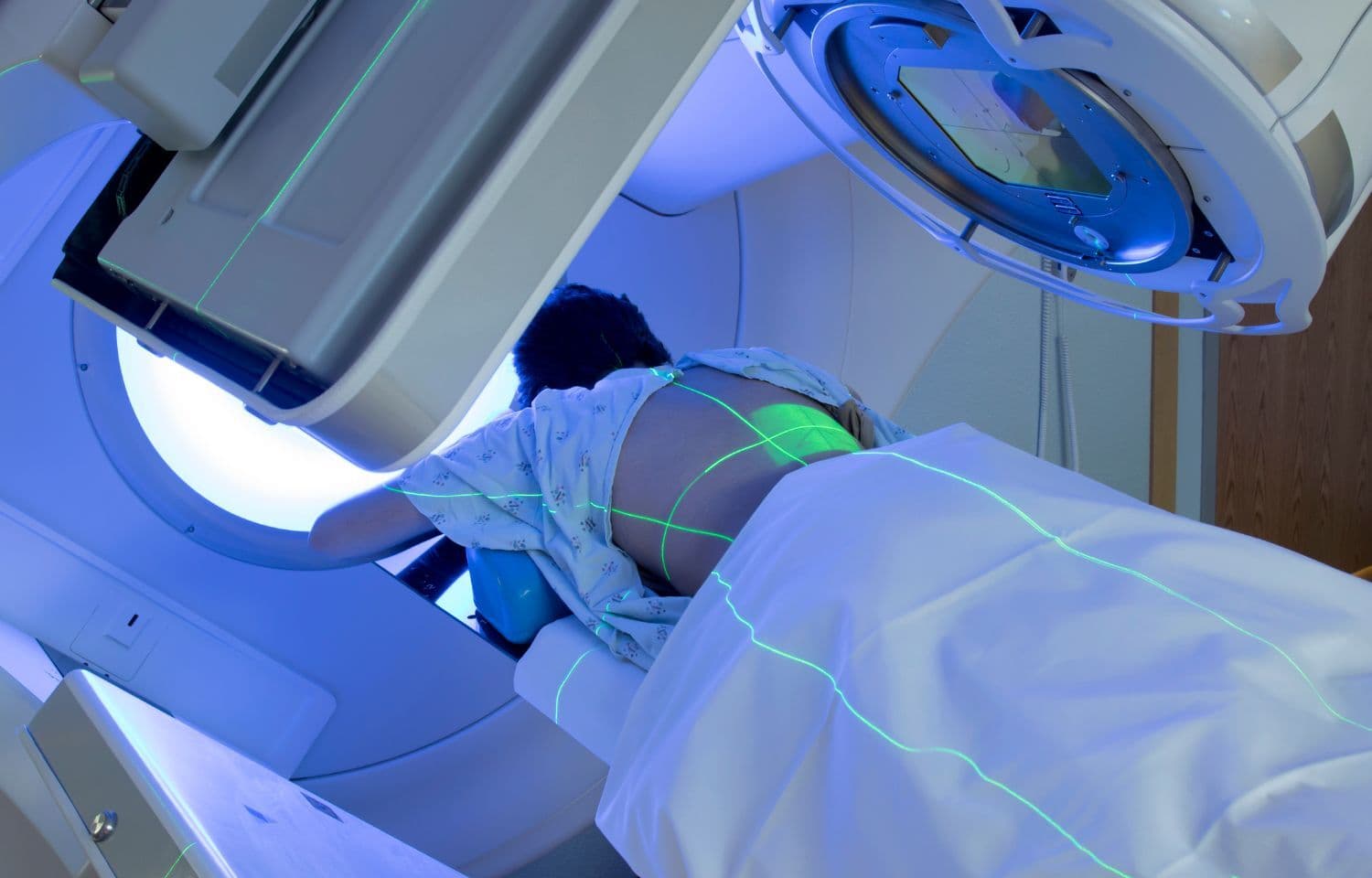 O’tkir radiatsion dermatit uchun foydali bakterial dekolonizatsiya