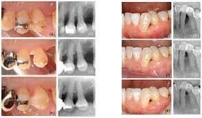 Murakkab natijalar o’lchovlari periodontal regenerativ terapiyadan keyin klinik natijalarni bashorat qilishga yordam beradi