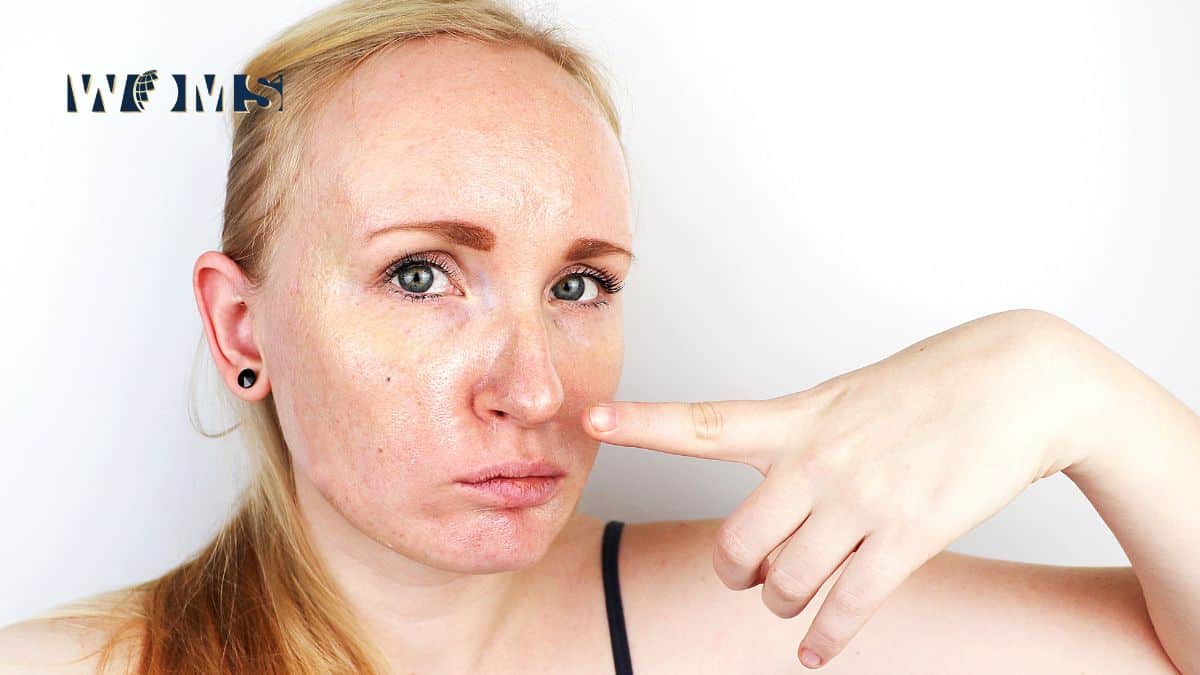 Nima uchun yog’li teriga hidratsiya kerak