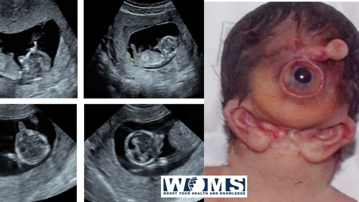 Otosefaliya: bir nechta malformatsiyalar bilan kam uchraydigan sindrom