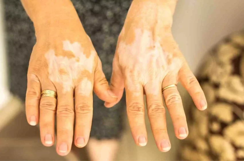  Maqsadli va butun tanadagi NB-UVB akral vitiligo bilan og’rigan bemorlar uchun samarali davolash usullaridir: Tadqiqot